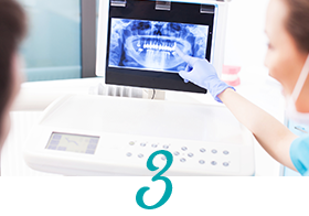 CTによるインプラント3D診断 イメージ画像